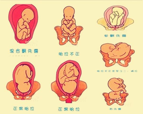 经产妇臀位坚持顺产(经产妇臀位坚持顺产有影响吗)
